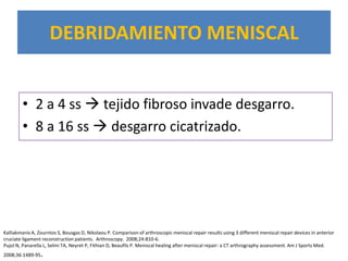 DEBRIDAMIENTO MENISCAL


        • 2 a 4 ss  tejido fibroso invade desgarro.
        • 8 a 16 ss  desgarro cicatrizado.




Kalliakmanis A, Zourntos S, Bousgas D, Nikolaou P. Comparison of arthroscopic meniscal repair results using 3 different meniscal repair devices in anterior
cruciate ligament reconstruction patients. Arthroscopy. 2008;24:810-6.
Pujol N, Panarella L, Selmi TA, Neyret P, Fithian D, Beaufils P. Meniscal healing after meniscal repair: a CT arthrography assessment. Am J Sports Med.
2008;36:1489-95   .
 