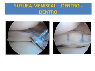 SUTURA MENISCAL : DENTRO -
        DENTRO
 