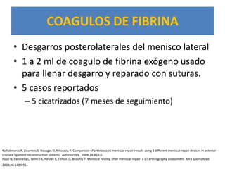 COAGULOS DE FIBRINA
        • Desgarros posterolaterales del menisco lateral
        • 1 a 2 ml de coagulo de fibrina exógeno usado
          para llenar desgarro y reparado con suturas.
        • 5 casos reportados
                – 5 cicatrizados (7 meses de seguimiento)




Kalliakmanis A, Zourntos S, Bousgas D, Nikolaou P. Comparison of arthroscopic meniscal repair results using 3 different meniscal repair devices in anterior
cruciate ligament reconstruction patients. Arthroscopy. 2008;24:810-6.
Pujol N, Panarella L, Selmi TA, Neyret P, Fithian D, Beaufils P. Meniscal healing after meniscal repair: a CT arthrography assessment. Am J Sports Med.
2008;36:1489-95   .
 