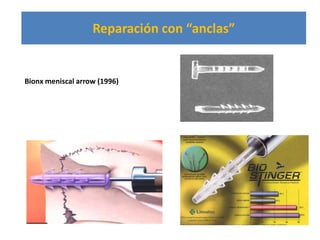 Reparación con “anclas”


Bionx meniscal arrow (1996)




                                             B Moyen
 