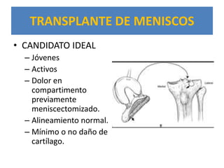 TRANSPLANTE DE MENISCOS
• CANDIDATO IDEAL
  – Jóvenes
  – Activos
  – Dolor en
    compartimento
    previamente
    meniscectomizado.
  – Alineamiento normal.
  – Mínimo o no daño de
    cartílago.
 