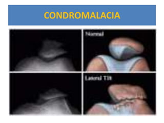 CONDROMALACIA
 