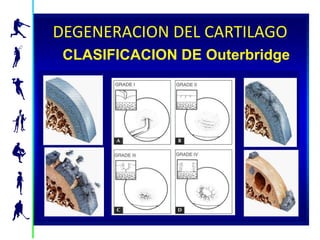 Cartilage Degeneration
DEGENERACION DEL CARTILAGO
    Outerbridge Classification System
 CLASIFICACION DE Outerbridge




                                        66032.A
                                        06/2002
 