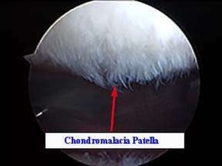 Fisiología meniscal
 