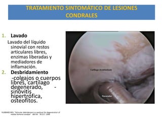 TRATAMIENTO SINTOMÁTICO DE LESIONES
                                       CONDRALES


1. Lavado
      Lavado del líquido
       sinovial con restos
       articulares libres,
       enzimas liberadas y
       mediadores de
       inflamación.
2. Desbridamiento
           -colgajos o cuerpos
          libres, cartílago
          degenerado,       -
          sinovitis
          hipertrófica,
          osteofítos.
HUBBARD MSJ. “Articular debridement vs washout for degeneration of
        medial femoral condyle” JBJS Br. 78:217 1996
 