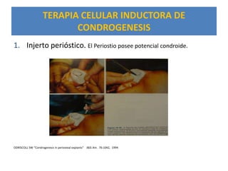 TERAPIA CELULAR INDUCTORA DE
                           CONDROGENESIS
1. Injerto perióstico. El Periostio posee potencial condroide.




ODRISCOLL SW “Condrogenesis in periosteal explants” JBJS Am. 76:1042, 1994
 