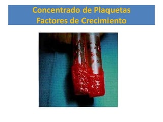 Concentrado de Plaquetas
 Factores de Crecimiento
 