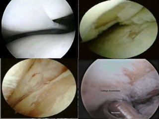 CONDROMALACIA
 