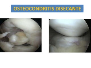 OSTEOCONDRITIS DISECANTE
 