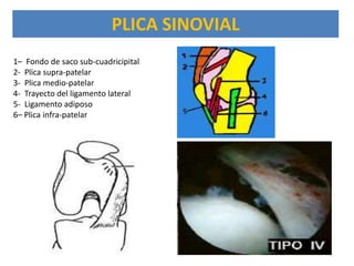 PLICA SINOVIAL
1– Fondo de saco sub-cuadricipital
2- Plica supra-patelar
3- Plica medio-patelar
4- Trayecto del ligamento lateral
5- Ligamento adiposo
6– Plica infra-patelar
 