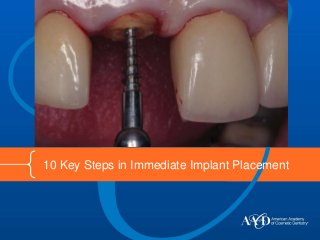 10 Key Steps in Immediate Implant Placement
 
