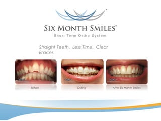 Straight Teeth. Less Time. Clear
Braces.
After Six Month SmilesBefore During
 
