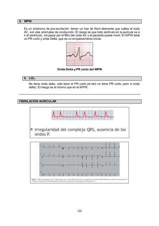 132
8. WPW:
Es un síndrome de pre-excitación: tienen un haz de Kent aberrante que saltea el nodo
AV, son vías anómalas de conducción. El riesgo es que todo estímulo en la aurícula va a
ir al ventrículo, sin pasar por el filtro del nodo AV y el paciente puede morir. El WPW tiene
un PR corto y onda Delta, que es un empastamiento inicial.
Onda Delta y PR corto del WPW
9. LGL:
No tiene onda delta, sólo tiene el PR corto (el otro no tiene PR corto, pero sí onda
delta). El riesgo es el mismo que en el WPW.
FIBRILACIÓN AURICULAR
 