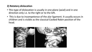 2) Rotatory dislocation
• This type of dislocation is usually in one plane (axial) and in one
direction only i.e. to the right or to the left.
• This is due to incompetence of the alar ligament. It usually occurs in
children and is visible as the classical Cocked Robin position of the
head.
 