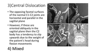 3)Central Dislocation
• The opposing facetal surfaces
of the normal C1-C2 joints are
horizontal and parallel in the
sagittal plane
• However, if these are
oriented obliquely in the
sagittal plane then the C2
body has a tendency to slip
upwards due to the weight of
the patient’s head during
flexion movements
4) Mixed
 