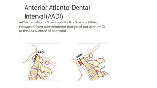 Anterior Atlanto-Dental
Interval(AADI)
AAS is + when >3mm in adults & >5mm in children
Measured from posteroinferior margin of ant arch of C1
to the ant surface of odontoid
 