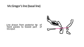 McGregor’s line (basal line)
Line drawn from posterior tip of
Hard palate to lowest part of
Occiput
 