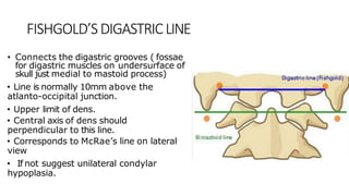 FISHGOLD’SDIGASTRICLINE
• Connects the digastric grooves ( fossae
for digastric muscles on undersurface of
skull just medial to mastoid process)
• Line is normally 10mm above the
atlanto-occipital junction.
• Upper limit of dens.
• Central axis of dens should
perpendicular to this line.
• Corresponds to McRae’s line on lateral
view
• If not suggest unilateral condylar
hypoplasia.
 