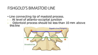 FISHGOLD’S BIMASTOIDLINE
• Line connecting tip of mastoid process.
• At level of atlanto-occipital junction
• Odontoid process should be less than 10 mm above
this line
 