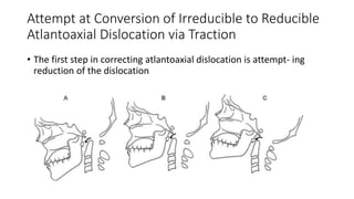 Attempt at Conversion of Irreducible to Reducible
Atlantoaxial Dislocation via Traction
• The first step in correcting atlantoaxial dislocation is attempt- ing
reduction of the dislocation
 