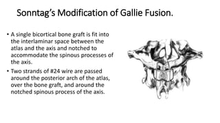 Sonntag’s Modification of Gallie Fusion.
• A single bicortical bone graft is fit into
the interlaminar space between the
atlas and the axis and notched to
accommodate the spinous processes of
the axis.
• Two strands of #24 wire are passed
around the posterior arch of the atlas,
over the bone graft, and around the
notched spinous process of the axis.
 