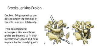 Brooks-JenkinsFusion
Doubled 20-gauge wires are
passed under the laminae of
the atlas and axis bilaterally.
Two posterolateral
autologous iliac crest bone
grafts are beveled to fit both
interlaminar spaces and held
in place by the overlying wire
 