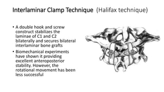 Interlaminar Clamp Technique (Halifax technique)
• A double hook and screw
construct stabilizes the
laminae of C1 and C2
bilaterally and secures bilateral
interlaminar bone grafts
• Biomechanical experiments
have shown it providing
excellent anteroposterior
stability. However, the
rotational movement has been
less successful
 
