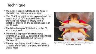 Technique
• The neck is kept neutral and the head is
placed in the military tuck position
• The C2-C3 facet joints are exposed and the
dorsal arch of C1 is exposed laterally
exposing the vertebral artery in the
vertebral groove on the superior aspect of
the C1 arch
• The lateral mass of C1 inferior to the C1
arch is exposed
• The medial aspect of the transverse
foramen at C1 and C2 can also be identified
and serve as a lateral limit for screw
placement
• The entry point for the C1 lateral mass
screw is identified at the centre of the C1
lateral mass
 