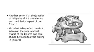 • Another entry is at the junction
of midpoint of C1 lateral mass
and the inferior aspect of the
C1 arch
• Vertebral artery often runs in a
sulcus on the superolateral
aspect of the C1 arch and care
should be taken to avoid drilling
in this area
 