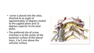 • screw is placed into the atlas,
directed at an angle of
approximately 15 degrees medial
to the sagittal plane and 15
degrees superior to the axial
plane.
• The preferred site of screw
insertion is at the center of the
posterior surface of the lateral
mass, 1 to 2 mm above the
articular surface.
 