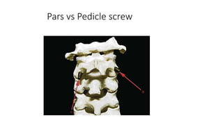 Pars vs Pedicle screw
 