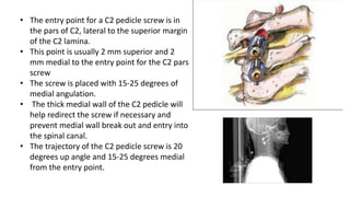 • The entry point for a C2 pedicle screw is in
the pars of C2, lateral to the superior margin
of the C2 lamina.
• This point is usually 2 mm superior and 2
mm medial to the entry point for the C2 pars
screw
• The screw is placed with 15-25 degrees of
medial angulation.
• The thick medial wall of the C2 pedicle will
help redirect the screw if necessary and
prevent medial wall break out and entry into
the spinal canal.
• The trajectory of the C2 pedicle screw is 20
degrees up angle and 15-25 degrees medial
from the entry point.
 
