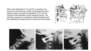 After screw placement in C1 and C2, a reduction ma-
neuver can be carried out, either by repositioning of the
patient’s head or by direct manipulation of C1 and C2,
using the instrumentation as the reduction device. The
reduction maneuver is monitored under fluoroscopy and
then stabilized by attachment of a small rod to the screws
 