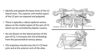 • Identify and palpate the bony limits of the C2
lateral mass. The superior and medial aspect
of the C2 pars are exposed and palpated.
• There is typically a robust epidural venous
plexus on the medial aspect of the pars of C2
which can be controlled by bipolar cautery.
• Do not dissect on the lateral portion of the
pars of C2, it increases the risk of bleeding
from the paravertebral venous plexus.
• This trajectory should cross the C1-C2 facet
joint and at the anterior arch of the atlas.
 