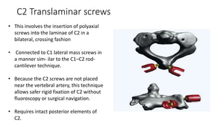 C2 Translaminar screws
• This involves the insertion of polyaxial
screws into the laminae of C2 in a
bilateral, crossing fashion
• Connected to C1 lateral mass screws in
a manner sim- ilar to the C1–C2 rod-
cantilever technique.
• Because the C2 screws are not placed
near the vertebral artery, this technique
allows safer rigid fixation of C2 without
fluoroscopy or surgical navigation.
• Requires intact posterior elements of
C2.
 