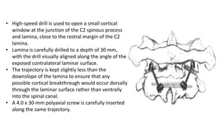 • High-speed drill is used to open a small cortical
window at the junction of the C2 spinous process
and lamina, close to the rostral margin of the C2
lamina.
• Lamina is carefully drilled to a depth of 30 mm,
with the drill visually aligned along the angle of the
exposed contralateral laminar surface.
• The trajectory is kept slightly less than the
downslope of the lamina to ensure that any
possible cortical breakthrough would occur dorsally
through the laminar surface rather than ventrally
into the spinal canal.
• A 4.0 x 30-mm polyaxial screw is carefully inserted
along the same trajectory.
 