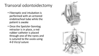 Transoral odontoidectomy
• Fiberoptic oral intubation is
performed with an armored
endotracheal tube while the
patient is awake
• Once the Spetzler-Sonntag
retractor is in place, a red
rubber catheter is placed
through one of the nares and
is sutured to the uvula using
4-0 Vicryl suture
 