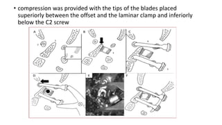 • compression was provided with the tips of the blades placed
superiorly between the offset and the laminar clamp and inferiorly
below the C2 screw
 
