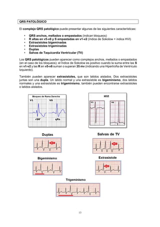 13
QRS PATOLÓGICO
El complejo QRS patológico puede presentar algunas de las siguientes características:
• QRS anchos, mellados o empastados (indican bloqueos)
• R altas en v5-v6 y S empastadas en v1-v2 (índice de Sokolow + indica HVI)
• Extrasístoles bigeminadas
• Extrasístoles trigeminadas
• Duplas
• Salvas de Taquicardia Ventricular (TV)
Los QRS patológicos pueden aparecer como complejos anchos, mellados o empastados
(en el caso de los bloqueos); el Índice de Sokolow es positivo cuando la suma entre las S
en v1-v2 y las R en v5-v6 suman o superan 35 mv (indicando una Hipertrofia de Ventrículo
Izquierdo).
También pueden aparecer extrasístoles, que son latidos aislados. Dos extrasístoles
juntas son una dupla. Un latido normal y una extrasístole es bigeminismo, dos latidos
normales y una extrasístole es trigeminismo, también pueden encontrarse extrasístoles
o latidos aislados.
 
