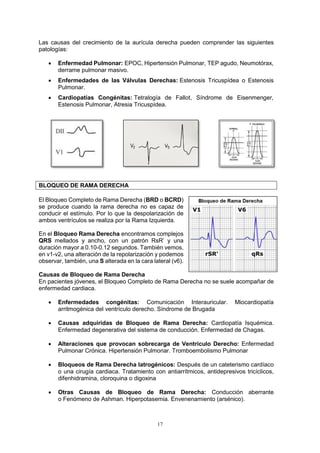 17
Las causas del crecimiento de la aurícula derecha pueden comprender las siguientes
patologías:
 Enfermedad Pulmonar: EPOC, Hipertensión Pulmonar, TEP agudo, Neumotórax,
derrame pulmonar masivo.
 Enfermedades de las Válvulas Derechas: Estenosis Tricuspídea o Estenosis
Pulmonar.
 Cardiopatías Congénitas: Tetralogía de Fallot, Síndrome de Eisenmenger,
Estenosis Pulmonar, Atresia Tricuspídea.
BLOQUEO DE RAMA DERECHA
El Bloqueo Completo de Rama Derecha (BRD o BCRD)
se produce cuando la rama derecha no es capaz de
conducir el estímulo. Por lo que la despolarización de
ambos ventrículos se realiza por la Rama Izquierda.
En el Bloqueo Rama Derecha encontramos complejos
QRS mellados y ancho, con un patrón RsR’ y una
duración mayor a 0.10-0.12 segundos. También vemos,
en v1-v2, una alteración de la repolarización y podemos
observar, también, una S alterada en la cara lateral (v6).
Causas de Bloqueo de Rama Derecha
En pacientes jóvenes, el Bloqueo Completo de Rama Derecha no se suele acompañar de
enfermedad cardiaca.
 Enfermedades congénitas: Comunicación Interauricular. Miocardiopatía
arritmogénica del ventrículo derecho. Síndrome de Brugada
 Causas adquiridas de Bloqueo de Rama Derecha: Cardiopatía Isquémica.
Enfermedad degenerativa del sistema de conducción. Enfermedad de Chagas.
 Alteraciones que provocan sobrecarga de Ventrículo Derecho: Enfermedad
Pulmonar Crónica. Hipertensión Pulmonar. Tromboembolismo Pulmonar
 Bloqueos de Rama Derecha Iatrogénicos: Después de un cateterismo cardíaco
o una cirugía cardiaca. Tratamiento con antiarrítmicos, antidepresivos tricíclicos,
difenhidramina, cloroquina o digoxina
 Otras Causas de Bloqueo de Rama Derecha: Conducción aberrante
o Fenómeno de Ashman. Hiperpotasemia. Envenenamiento (arsénico).
 