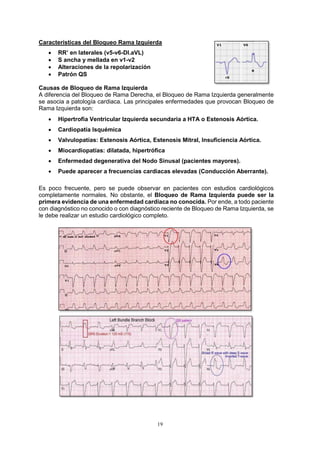 19
Características del Bloqueo Rama Izquierda
 RR’ en laterales (v5-v6-DI.aVL)
 S ancha y mellada en v1-v2
 Alteraciones de la repolarización
 Patrón QS
Causas de Bloqueo de Rama Izquierda
A diferencia del Bloqueo de Rama Derecha, el Bloqueo de Rama Izquierda generalmente
se asocia a patología cardiaca. Las principales enfermedades que provocan Bloqueo de
Rama Izquierda son:
 Hipertrofia Ventricular Izquierda secundaria a HTA o Estenosis Aórtica.
 Cardiopatía Isquémica
 Valvulopatías: Estenosis Aórtica, Estenosis Mitral, Insuficiencia Aórtica.
 Miocardiopatías: dilatada, hipertrófica
 Enfermedad degenerativa del Nodo Sinusal (pacientes mayores).
 Puede aparecer a frecuencias cardiacas elevadas (Conducción Aberrante).
Es poco frecuente, pero se puede observar en pacientes con estudios cardiológicos
completamente normales. No obstante, el Bloqueo de Rama Izquierda puede ser la
primera evidencia de una enfermedad cardiaca no conocida. Por ende, a todo paciente
con diagnóstico no conocido o con diagnóstico reciente de Bloqueo de Rama Izquierda, se
le debe realizar un estudio cardiológico completo.
 