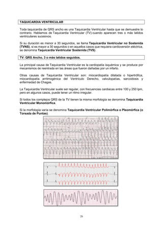 26
TAQUICARDIA VENTRICULAR
Toda taquicardia de QRS ancho es una Taquicardia Ventricular hasta que se demuestre lo
contrario. Hablamos de Taquicardia Ventricular (TV) cuando aparecen tres o más latidos
ventriculares sucesivos.
Si su duración es menor a 30 segundos, se llama Taquicardia Ventricular no Sostenida
(TVNS), si es mayor a 30 segundos o en aquellos casos que requiera cardioversión eléctrica,
se denomina Taquicardia Ventricular Sostenida (TVS).
TV: QRS Ancho, 3 o más latidos seguidos.
La principal causa de Taquicardia Ventricular es la cardiopatía isquémica y se produce por
mecanismos de reentrada en las áreas que fueron dañadas por un infarto.
Otras causas de Taquicardia Ventricular son: miocardiopatía dilatada o hipertrófica,
miocardiopatía arritmogénica del Ventrículo Derecho, valvulopatías, sarcoidosis y
enfermedad de Chagas.
La Taquicardia Ventricular suele ser regular, con frecuencias cardiacas entre 100 y 250 lpm,
pero en algunos casos, puede tener un ritmo irregular.
Si todos los complejos QRS de la TV tienen la misma morfología se denomina Taquicardia
Ventricular Monomórfica.
Si la morfología varía se denomina Taquicardia Ventricular Polimórfica o Pleomórfica (o
Torsada de Puntas).
 