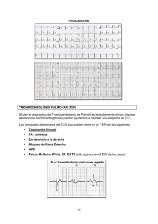 30
PERICARDITIS
TROMBOEMBOLISMO PULMONAR (TEP)
Si bien el diagnóstico del Tromboembolismo de Pulmón es esencialmente clínico, algunas
alteraciones electrocardiográficas pueden ayudarnos a reforzar una sospecha de TEP.
Las principales alteraciones del ECG que pueden verse en un TEP son las siguientes:
• Taquicardia Sinusal
• FA - arritmias
• Eje desviado a la derecha
• Bloqueo de Rama Derecha
• HVD
• Patrón McGuinn White: S1, Q3 T3 (sólo aparece en el 15% de los casos)
 