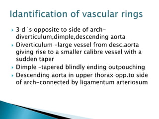  3 d΄s opposite to side of arch-
diverticulum,dimple,descending aorta
 Diverticulum –large vessel from desc.aorta
giving rise to a smaller calibre vessel with a
sudden taper
 Dimple –tapered blindly ending outpouching
 Descending aorta in upper thorax opp.to side
of arch-connected by ligamentum arteriosum
 