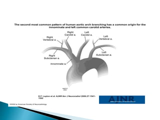 The second most common pattern of human aortic arch branching has a common origin for the
innominate and left common carotid arteries.
K.F. Layton et al. AJNR Am J Neuroradiol 2006;27:1541-
1542
©2006 by American Society of Neuroradiology
 