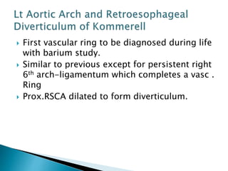  First vascular ring to be diagnosed during life
with barium study.
 Similar to previous except for persistent right
6th arch-ligamentum which completes a vasc .
Ring
 Prox.RSCA dilated to form diverticulum.
 