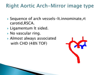  Sequence of arch vessels-lt.innominate,rt
carotid,RSCA.
 Ligamentum lt sided.
 No vascular ring.
 Almost always associated
with CHD (48% TOF)
 