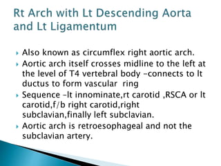  Also known as circumflex right aortic arch.
 Aortic arch itself crosses midline to the left at
the level of T4 vertebral body -connects to lt
ductus to form vascular ring
 Sequence –lt innominate,rt carotid ,RSCA or lt
carotid,f/b right carotid,right
subclavian,finally left subclavian.
 Aortic arch is retroesophageal and not the
subclavian artery.
 