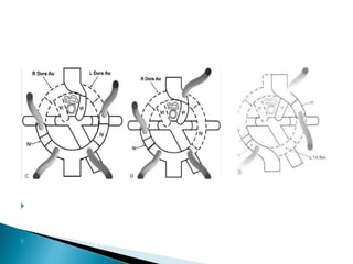  AAAaa
 Type A Type B
 