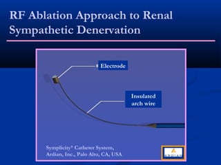 RF Ablation Approach to Renal
Sympathetic Denervation

                            Electrode



                                         Insulated
                                         arch wire




      Symplicity® Catheter System,
      Ardian, Inc., Palo Alto, CA, USA
 